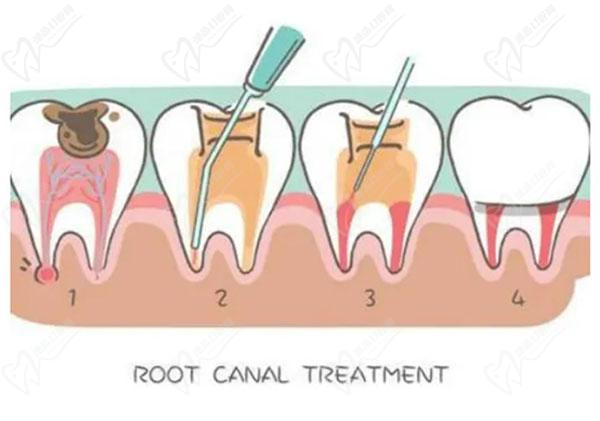 根管治疗