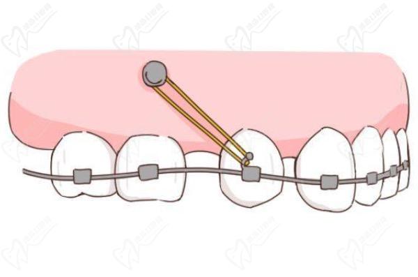正畸牙齿打骨钉为什么会松动？