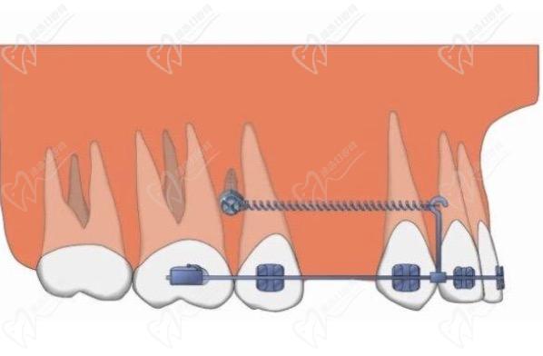 正畸牙齿打骨钉为什么会松动？