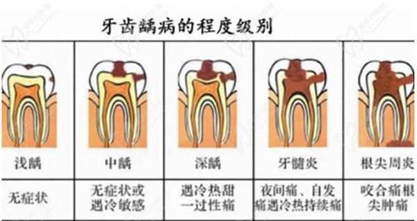 龋齿一度到五度图片请查看，龋齿蛀牙牙齿龋坏程度等级分级是这样