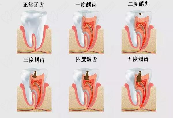 龋齿一度到五度图片请查看，龋齿蛀牙牙齿龋坏程度等级分级是这样