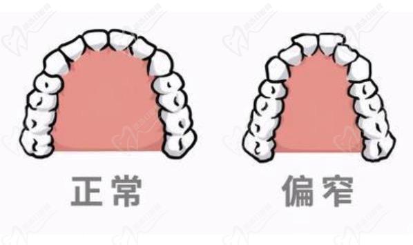 牙弓狭窄有必要矫正吗？