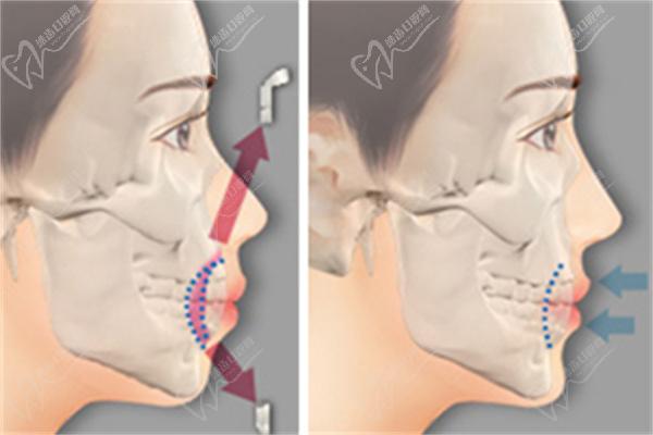 双鄂手术与正颌手术切法不同