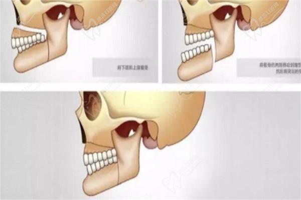 正颌手术只适合上下牙颌复位