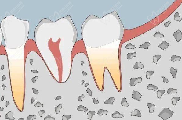 我的牙根断了还能修复吗？