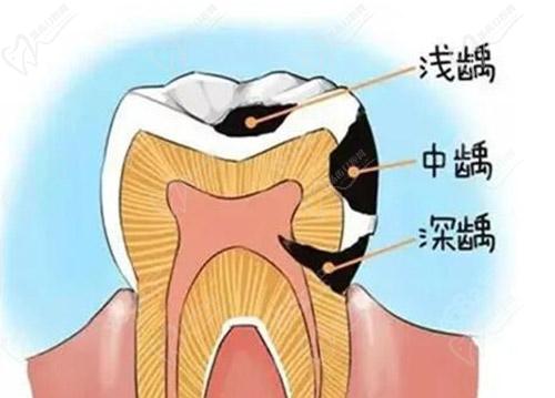 乳牙蛀牙的程度