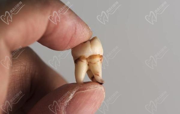 十种智齿不能拔的图片请收好，有人拔牙伤到神经三年了还没恢复