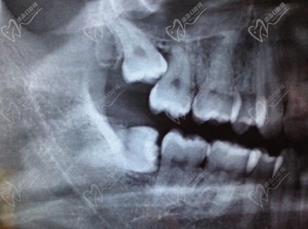 十种智齿不能拔的图片请收好，有人拔牙伤到神经三年了还没恢复