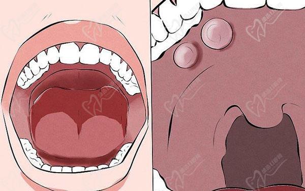 种植牙后口腔癌变几率大吗？口腔癌的7个前兆你一定要清楚