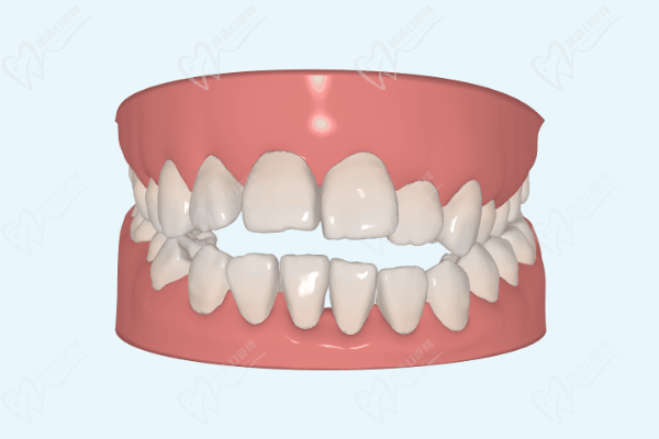 骨性龅牙可以通过牙套矫正吗？