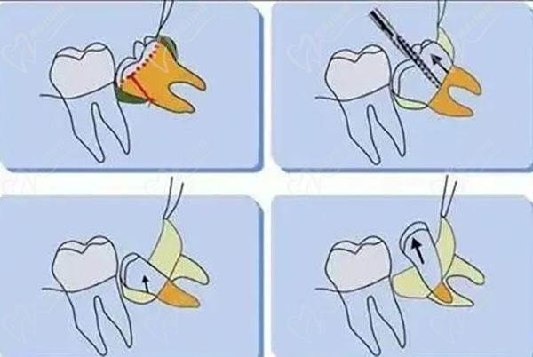 超声骨刀拔牙和普通拔牙的区别