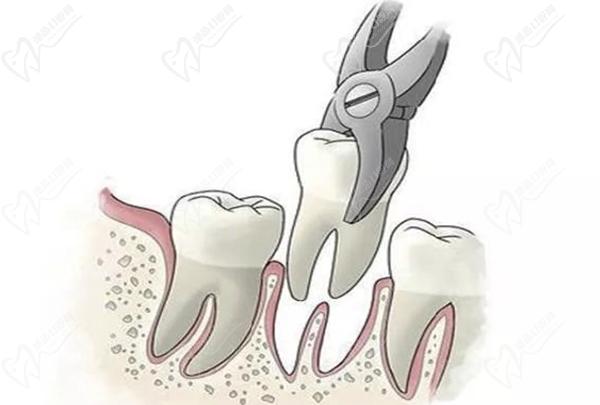 超声骨刀拔牙和普通拔牙的区别
