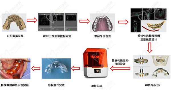 3D数字化导板种植术即刻种植术过程图