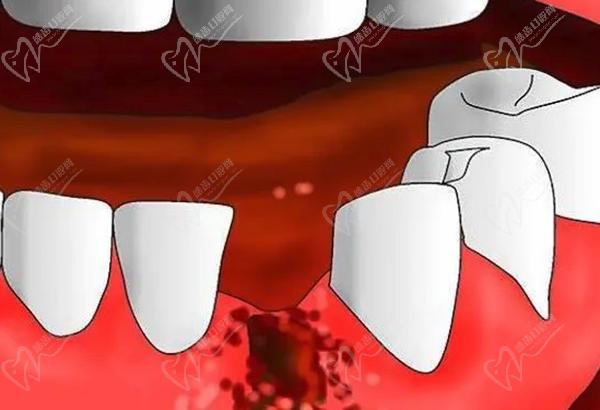 拔完牙第二天醒来满嘴都是血正常吗？拔牙后十大禁忌症你一定要清楚