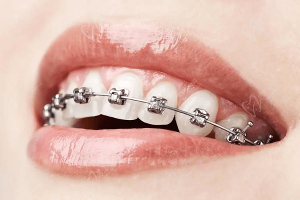 怎么判断骨性龅牙的轻重程度