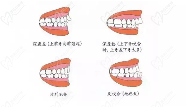 全同步带状弓矫正价格 全同步带状弓矫正价格