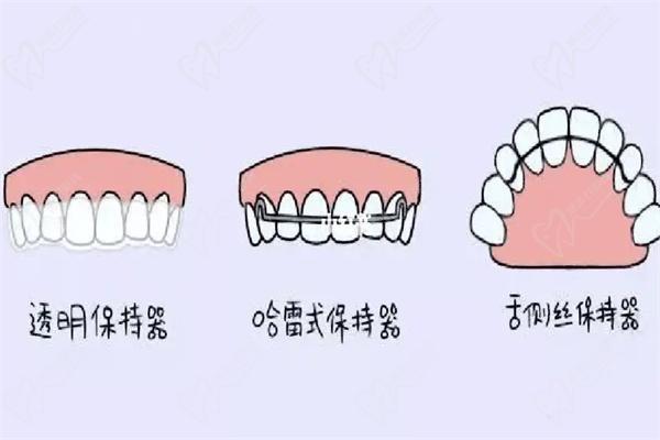 牙齿正畸保持器不同种类