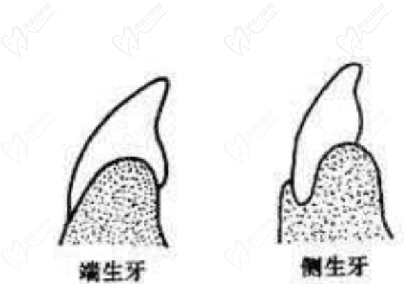 端生牙和侧生牙