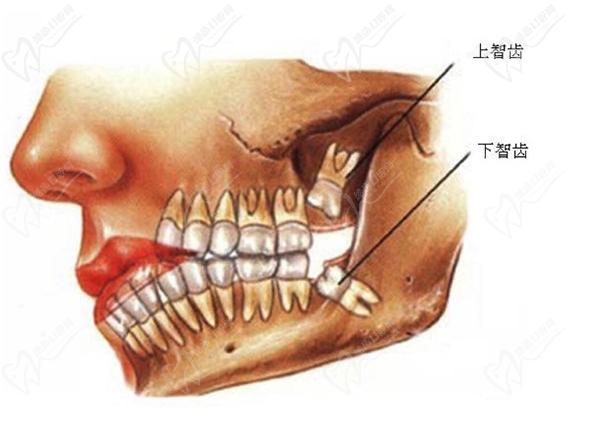 牙医亲戚说智齿不能拔，但是拔智齿后真舒服再也不难受了