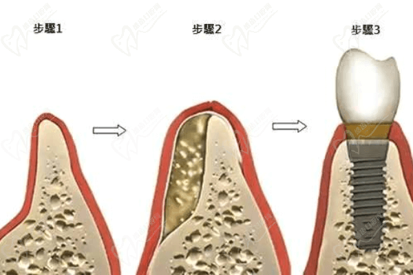 根管治疗是自费还是报销<span style=
