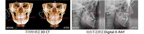 韩国Faceline整形外科医院双鄂手术