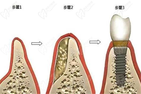 牙槽骨萎缩种植牙步骤