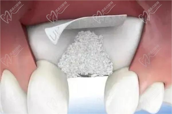 牙槽骨萎缩种植牙术前准备