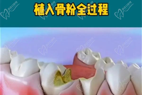 牙齿骨萎缩植入骨粉