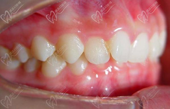 牙床高是什么原因造成的？