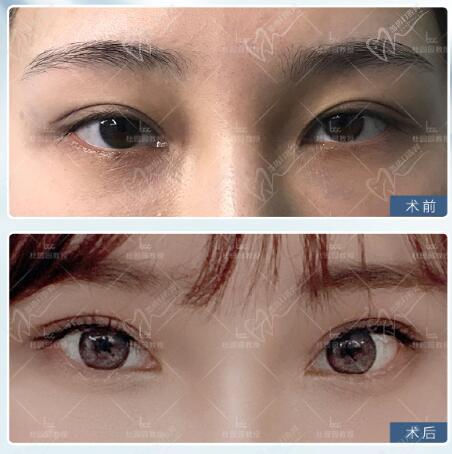 上海杜园园修复双眼皮对比