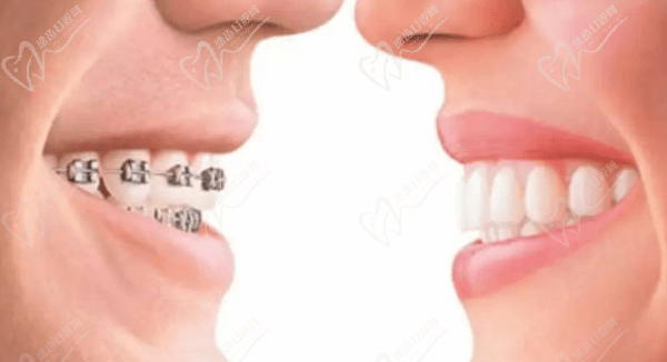 门牙外凸可以只矫正上面的牙齿吗
