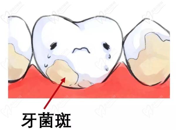 什么是牙菌斑