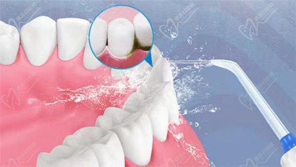 严 重牙菌斑怎么去除?