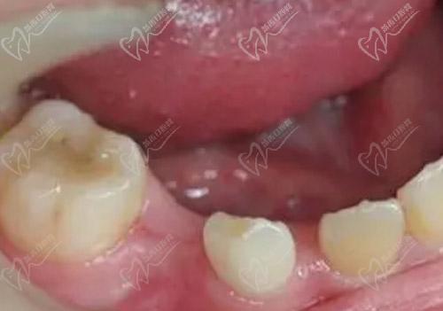 乳牙早失的常见原因是什么
