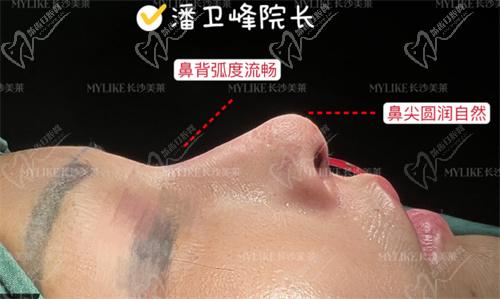 ,长沙美莱潘卫峰做个鼻子多少钱? ,长沙美莱潘卫峰做个鼻子多少钱?