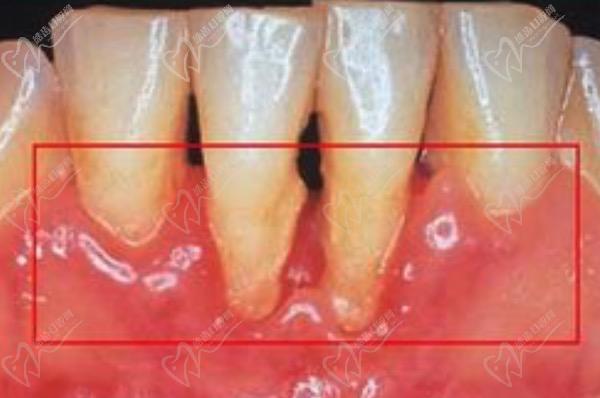 牙槽骨吸收是什么意思？