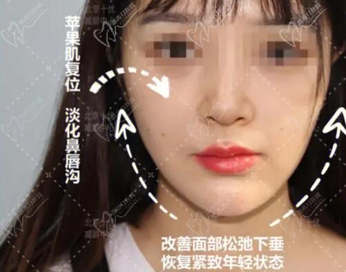 冯立哲面部提升怎么样