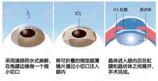 岳辉眼科医生擅长ICL晶体植入手术