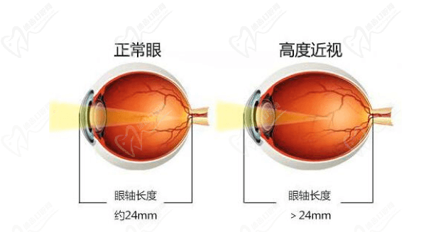 正常眼和高度近视的区别