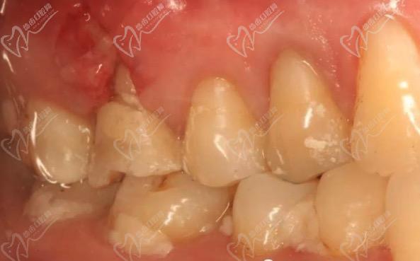 牙槽骨吸收可以恢复吗？