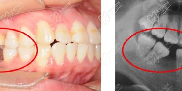 牙槽骨吸收可以恢复吗？