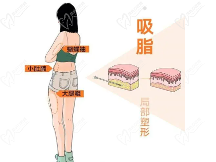 手术吸脂凹凸不平