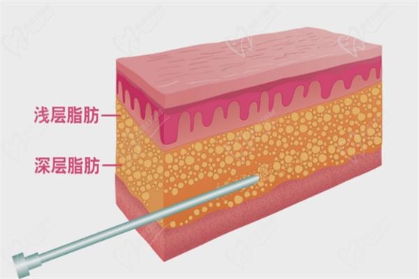 手术吸脂凹凸不平修复