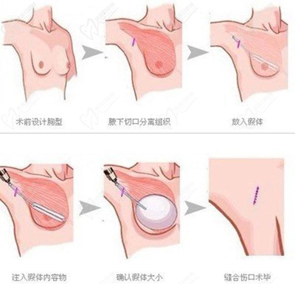 武汉五洲隆胸价格