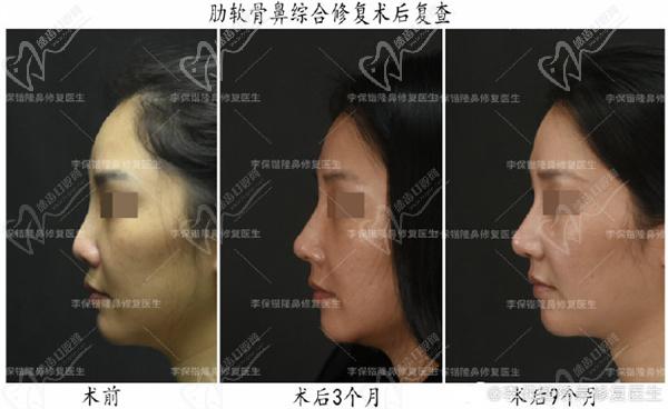 杭州清锴整形李保锴鼻整形真人图片
