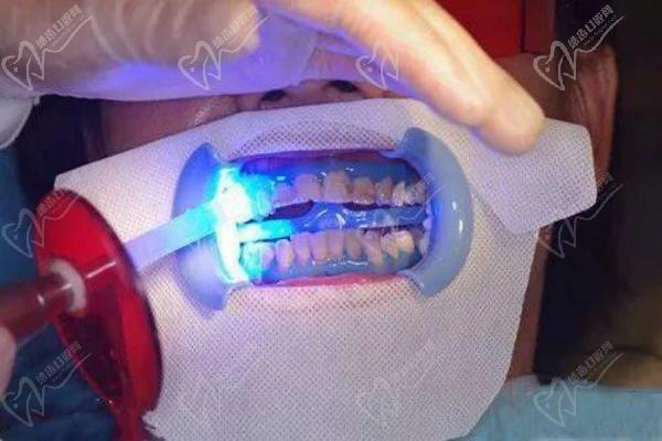 牙齿激光美白过程