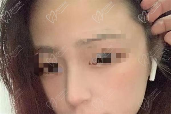 深圳阳光医院罗志敏鼻子做的怎么样