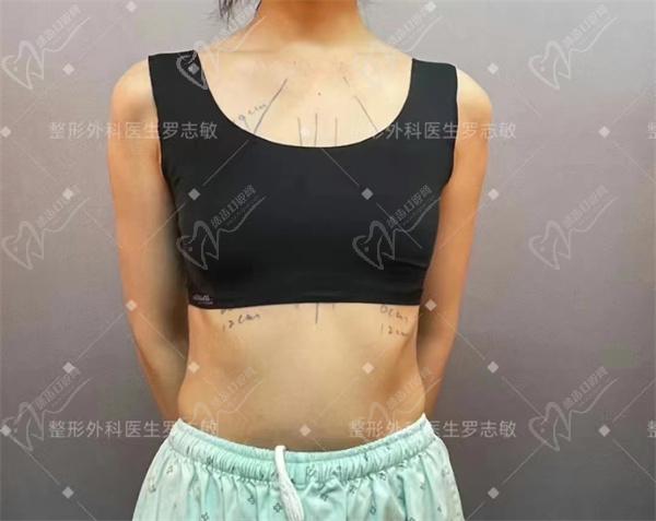 深圳阳光医院罗志敏做胸怎样