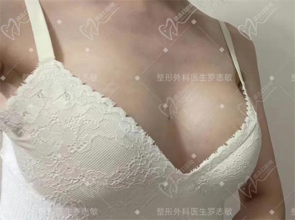 深圳阳光医院罗志敏做胸怎样
