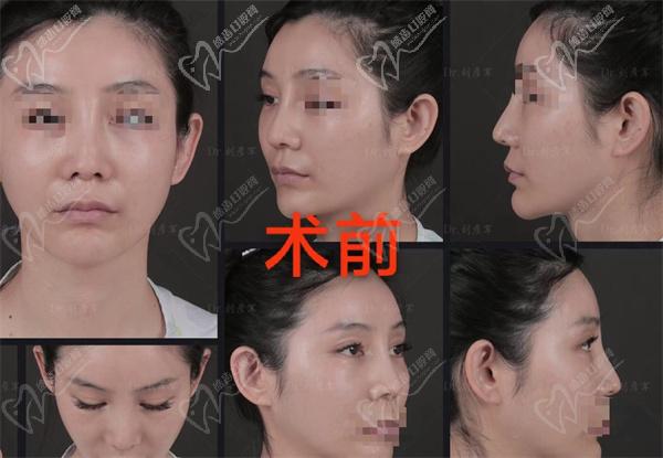 刘彦军鼻修复价格
